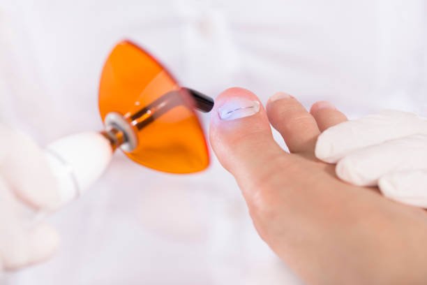 Рodologist (podiatrist) in gloves puts a titanium thread on a toenail with special polymerization