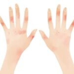 Poison Ivy Rash Stages You Must Know