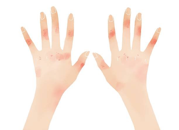 Poison Ivy Rash Stages You Must Know