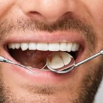 Gum Line Filling: A Complete Guide to Protect Your Teeth and Smile
