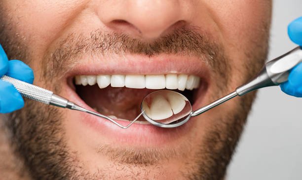 Gum Line Filling: A Complete Guide to Protect Your Teeth and Smile