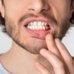 Inflamed Gums After Cleaning: Understanding Causes, Symptoms, and Effective Remedies for Oral Health