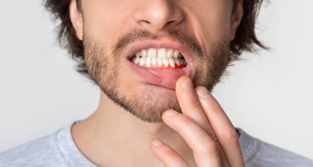 Inflamed Gums After Cleaning: Understanding Causes, Symptoms, and Effective Remedies for Oral Health